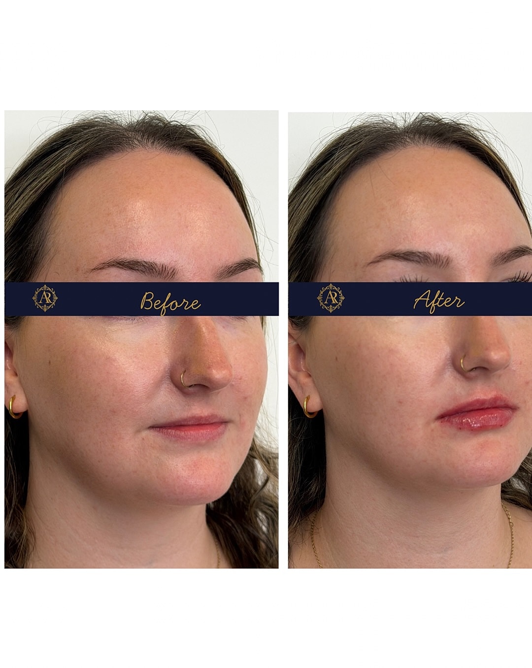 Lip Fillers  Before & After