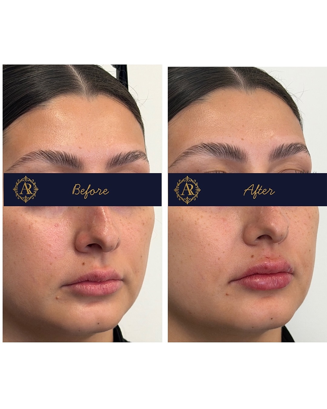 Lip Fillers  Before & After