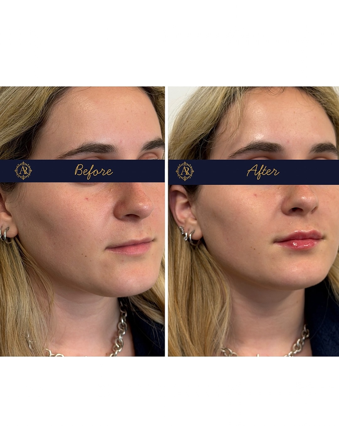 Lip Fillers  Before & After